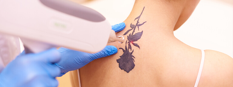 Woman with a neck tattoo receiving laser tattoo removal treatment